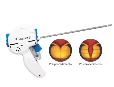 UroLift®